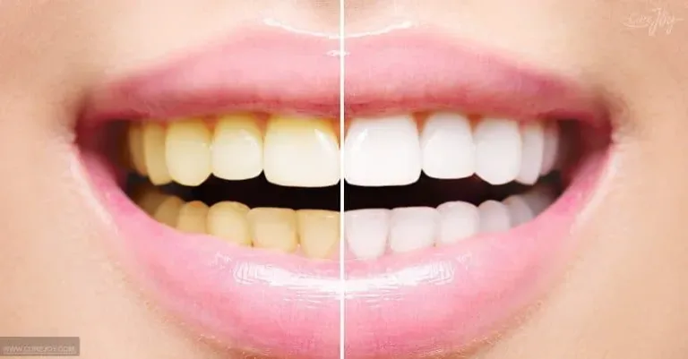blanchir les dents